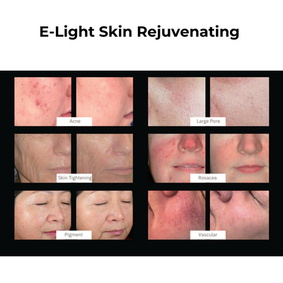 DermaLaze Skin Rejuvenation System with IPL SHR & E-Light