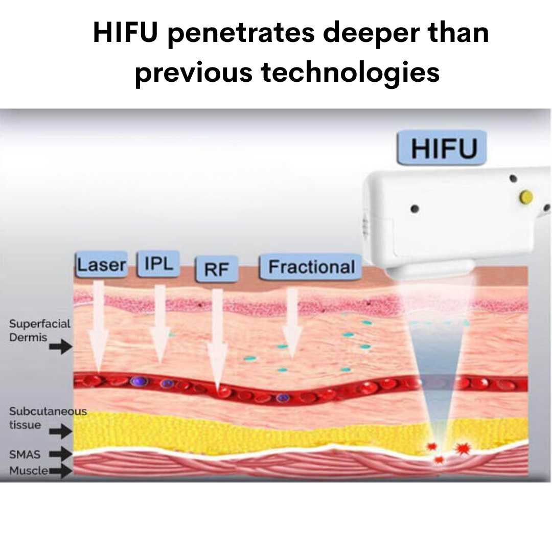 9D Face Lifting HIFU Machine