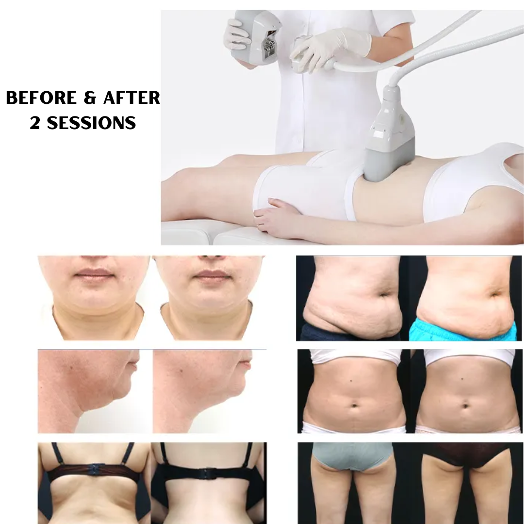 CoolContours Fat Freezing Mini with 6 Medical Grade Applicators