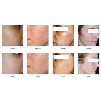 DermaLaze Skin Rejuvenation System with IPL SHR & E-Light