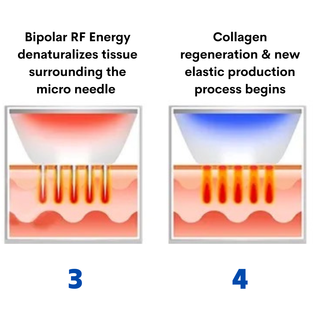 Beauty Disruptor RF Microneedling Machine 3 in 1