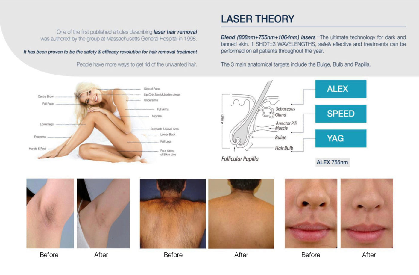 Elite Smooth Hair Removal Diode Laser Portable