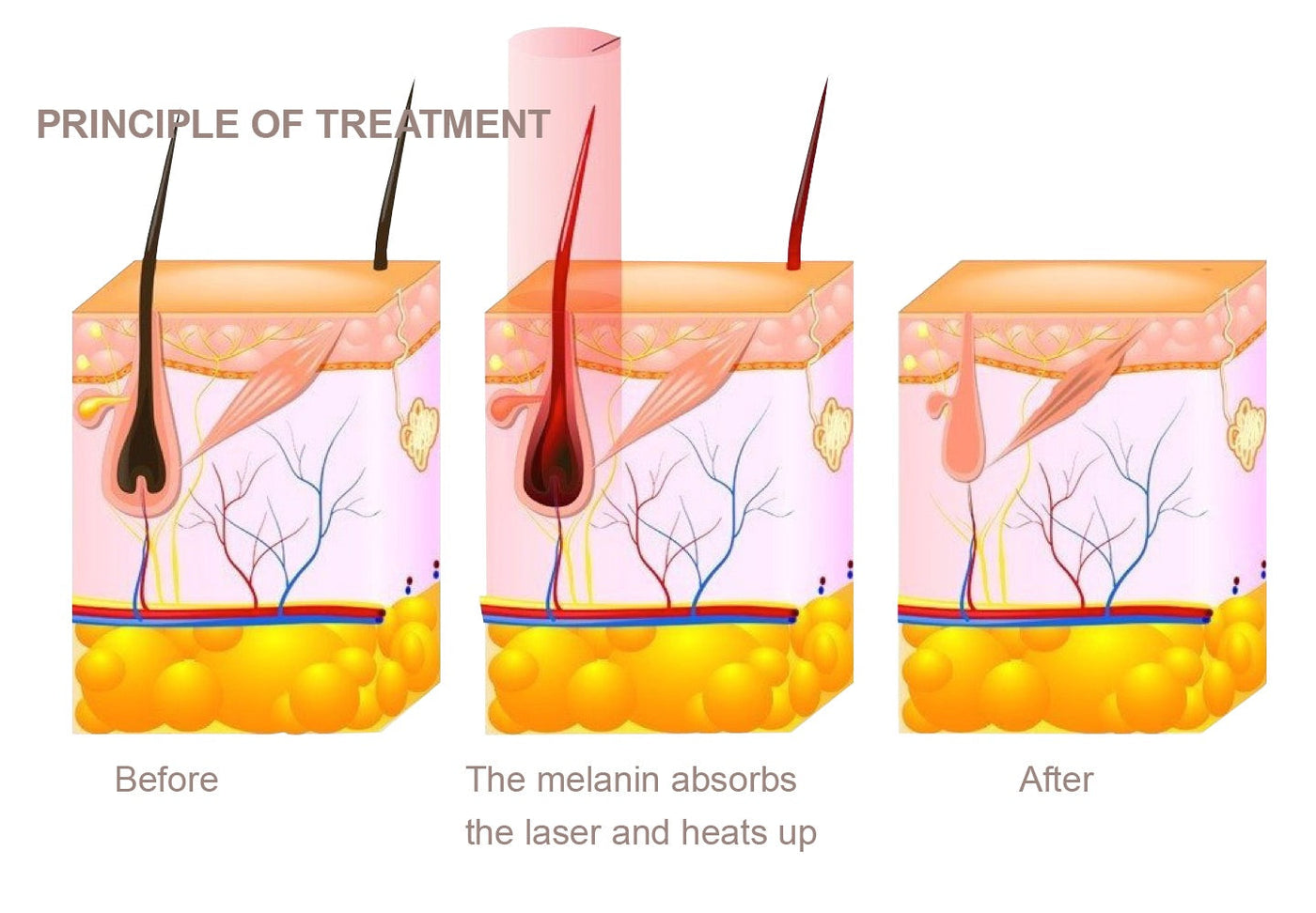 DiolaSheer Ice Hair Removal Laser Machine with Dual Handles